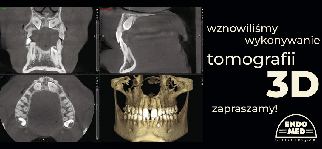 tomografia komputerowa 3d zębów stomatologia wrocław